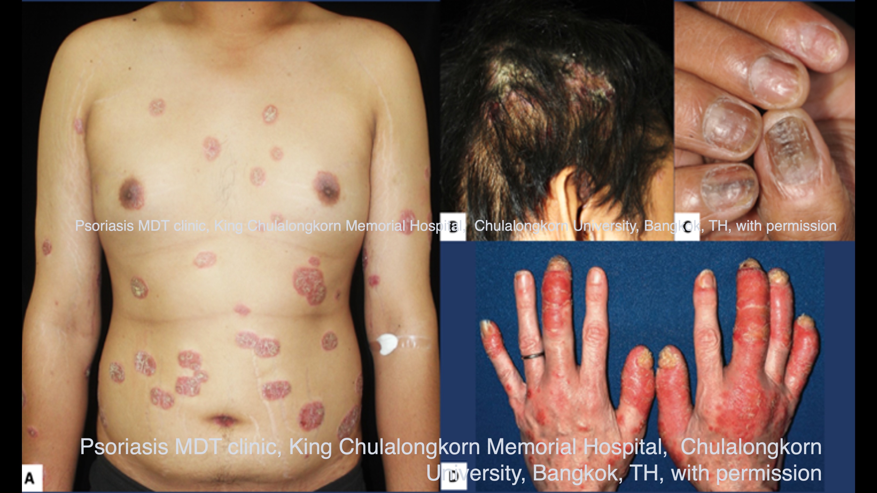 Staying Home for Long… With Psoriasis